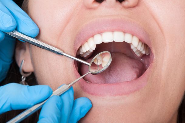 Svolta nella lotta contro la carie: i ricercatori sviluppano un gel miracoloso per i denti